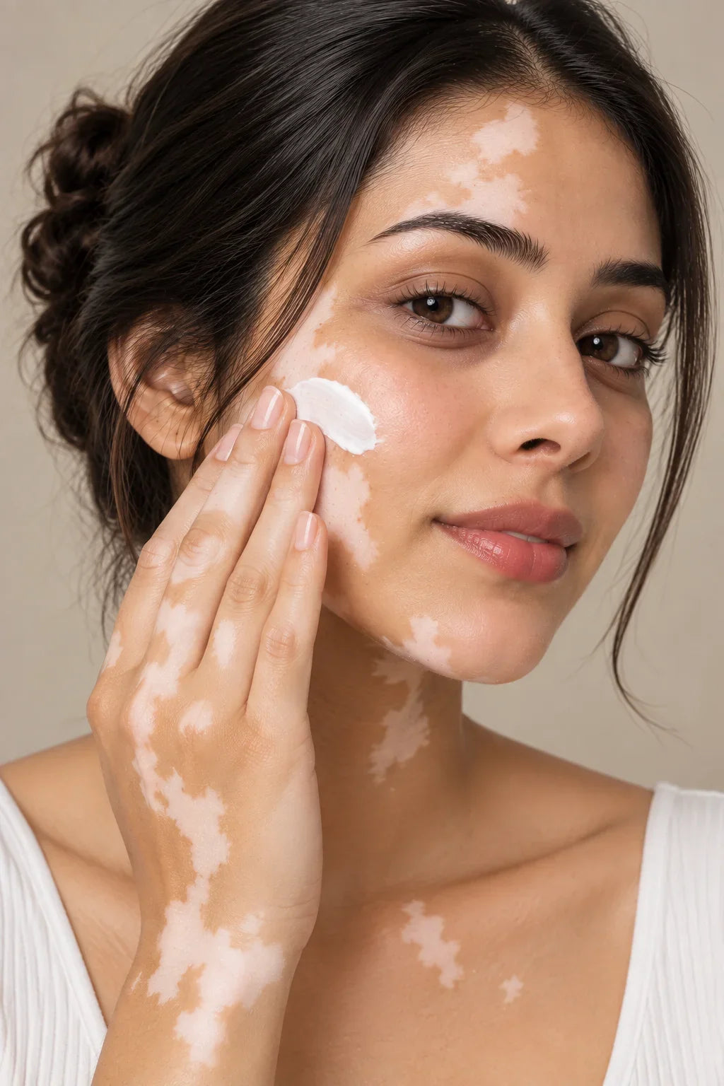 Vitiligo Management